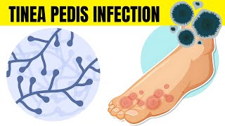 Tinea Pedis Infection (Athlete's Foot) - Causes, Types, Signs & Symptoms, And Treatment