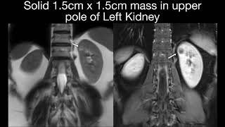 Renal Cell Carcinoma Case 23