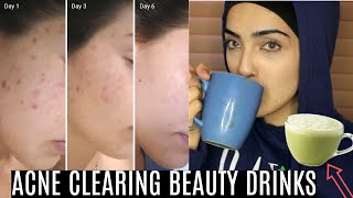 TWO ACNE/PIMPLE REMOVING BEAUTY DRINKS THAT WORK! (Bonus Weight Loss)~ Immy