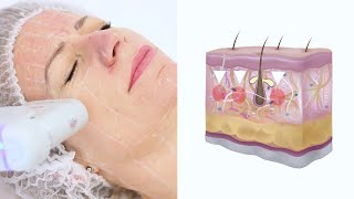 HIFU - Lifting facial fără bisturiu, singurul aprobat de FDA!