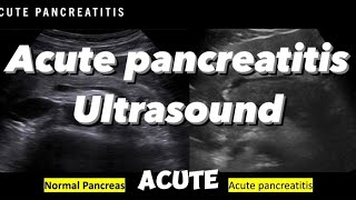 Acute pancreatitis ultrasonographic findings (Pancreas ultrasound part II)