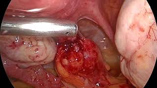 Bad IUD ..  perforating uterosacral into rectum منظار لعلاج لولب خارج الرحم