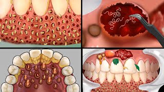 ASMR Remove Botfly Maggots inside Dirty Mouth | Dental care animation