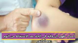 أسباب الزروقية المفاجئة في الجسم #الكدمات #shorts