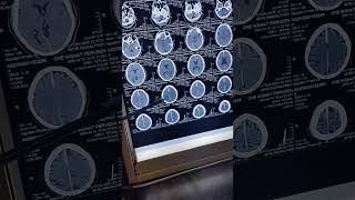 interhemisphetic subdural hematoma #neurology #bleeding #brainbleed #science