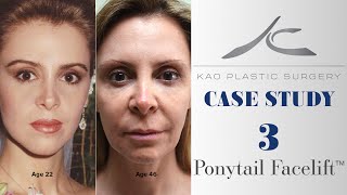 Case Study 3: Zonia (Ponytail Facelift™)