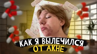 КАК ВЫЛЕЧИТЬСЯ ОТ АКНЕ ?