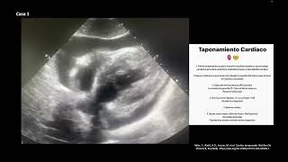 Casos de Taponamiento Cardíaco