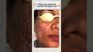 TCA Cross for Acne Scar  #shorts #acnescar #acnetreatment #acneproneskin #acneremoval