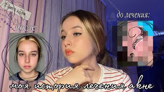 ✨моя история лечения акне/ как я смогла побороть эту проблему?✨