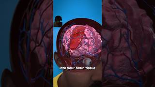 What is a brain aneurysm?