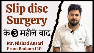 Slip disc Surgery के 1 महीने बाद | Slip Disc Spine Surgery In Delhi