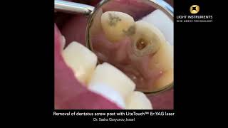 Removal of dentatus screw post with LiteTouch™ Er:YAG laser