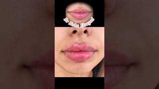 Lip filler ❤️💋🥰#الذكاء_الاصطناعي #lips #rejuvenation #botox #شد #lipfiller