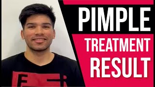 Best Pimple treatment | Best Acne Treatment | Sakhiya Skin Clinic Review