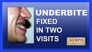 Fix Underbite Without Orthognathic Surgery