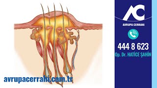 Kıl Dönmesi (Pilonidal Sinüs) Nedir? (Kıl Batıkları)