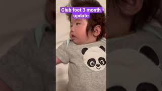 #clubfoot #clubfootjourney