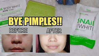 BEST ACNE SOAP + PAMPAPUTI || SNAIL BODY WHITE ACNE WHITENING SOAP REVIEW