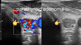 Parathyroid Adenoma left lower pole: Ultrasound and Color Doppler Imaging, Diagnosis and Management