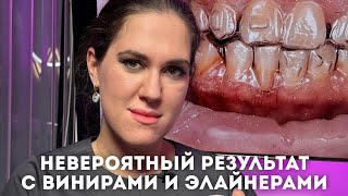 Невероятный результат с винирами и элайнерами