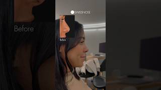 3 Weeks after Rhinoplasty | Dr. med. Simon Zimmermann