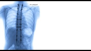 Testimonial video - Stem cell treatments for severe lumbar pain due to scoliosis (harrington rods)