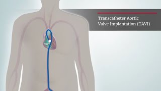 Aortic Stenosis _ TAVI procedure