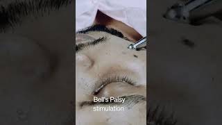 Bell's Palsy stimulation #physiotherapy #paralysis #bellspalsy #stimulation #healing #nerves #drsrk