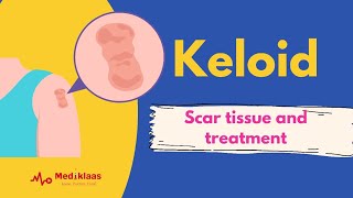 Keloid- scar tissue and treatment?