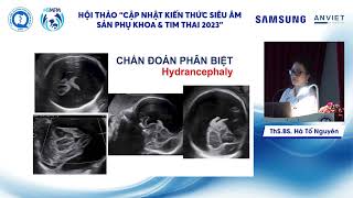 Các bất thường hệ thường kinh trung ương thường gặp - Ths. BS. Hà tố Nguyên