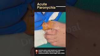 How to cure Acute paronychia ( Nail infection) surgery @designerdoctor #shorts #nail #infection