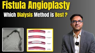 Dialysis का सबसे अच्छा तरीका कौनसा होता है ? | Fistulas or Catheters ? Fistula Angioplasty .