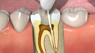 Як зробити лікування каналів зуба