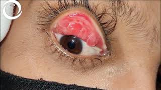 Giant Papillary Conjunctivitis