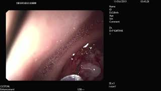 Endoscopic Polypectomy for Gastric Antral Polyp