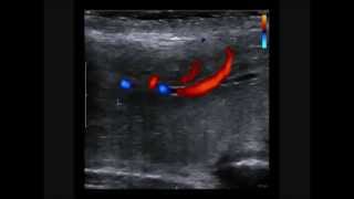 סונר (אולטראסאונד) דופלר של הפין - Penile Ultrasound Doppler