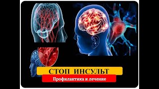 Что такое-ИНСУЛЬТ? / Как распознать инсульт? / причины, симптомы, лечение