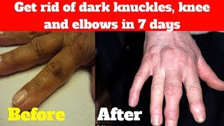 Hands Whitening | Get rid of dark knuckles, knee and elbows in 7 days - 100% Result (GUARANTEED)