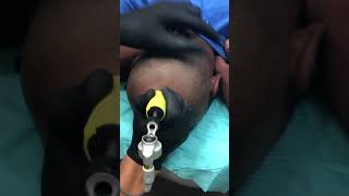 Scalp Micropigmentation - Antonio Baroque (Quick demonstration)