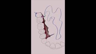 M suture in Endodontics - Animation