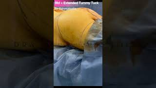 Bbl and extended tummy tuck