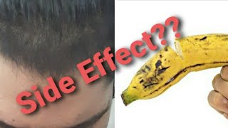 Minoxidil 5%||साइड इफेक्ट(Side effect)|| 10 months use | hindi