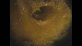 Temporal bone dissection microscopic part1(unedited)-dr.shreekantha acharya