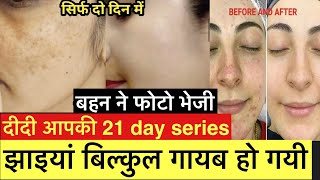 मेरी झाइयां कैसे गई आपके सारे सवालों के जवाब /pigmention से 100%छुटकारा कैसे पाया/ Skin Care routine