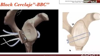 Recurrent Posterior Shoulder Instability