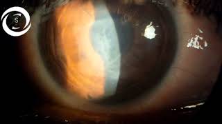 Ophthalmic Signs Cornea