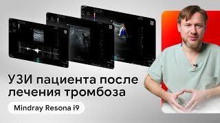 УЗИ вен нижних конечностей после лечения тромбоза на Mindray Resona i9