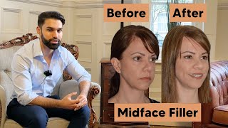 Midface Rejuvenation Filler Transformation