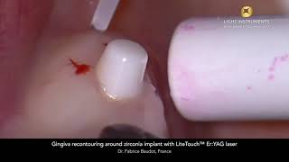 Gingiva recontouring around zirconia implant with LiteTouch™ Er:YAG laser